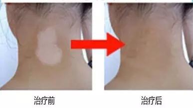 白癜风治疗最重要的几点要谨记！
